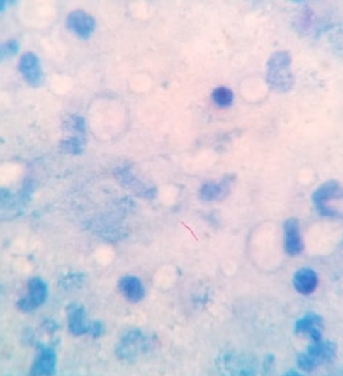 Acid fast bacilli in pleural fluid (1000X, Ziehl - Neelsen stain)