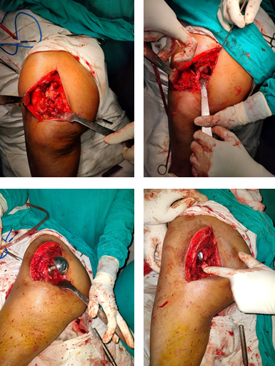 Surgical Steps