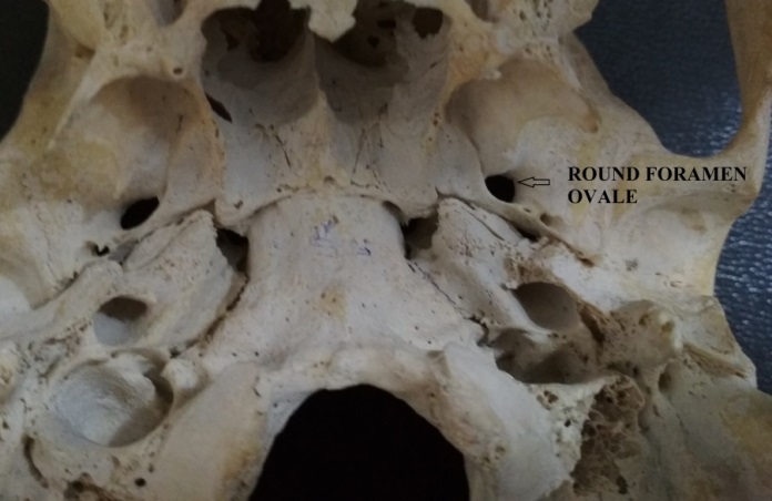 Photograph of base of skull showing round shaped left foramen ovale.