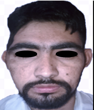 Frontal view of the cranial defect after craniotomy