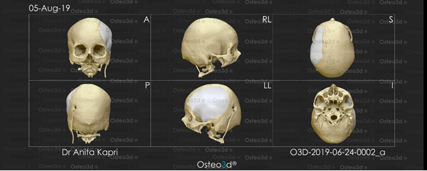 Ranial Prosthesis design using the software