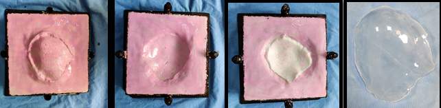 Laboratory Fabrication of heat cure PMMA cranial prosthesis