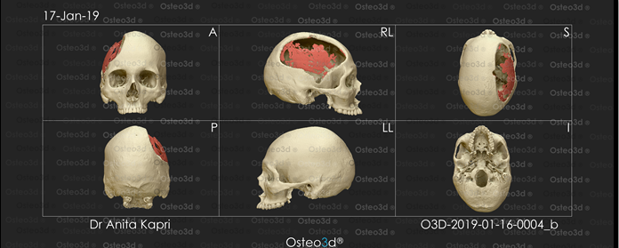 CT showing a 12 × 8 cm right cranial defect.