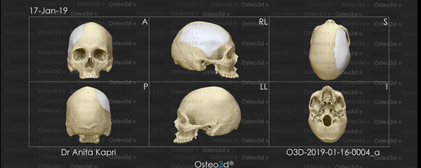 The cranial prosthetic design using the software
