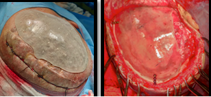 Intraoperative placement of PMMA Prosthesis