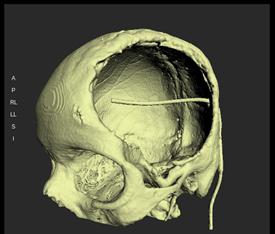 CT Scan data of the cranial defect