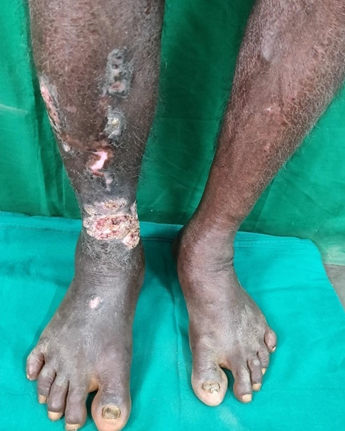 Lichen planus transforming to keratoacanthoma