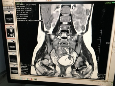 Heterogenous lesion in cervical canal