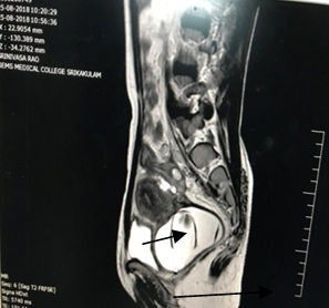 Heterogenouslesion in cervical canal surrounded by fluid (arrow)