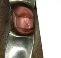 Vaginal septum