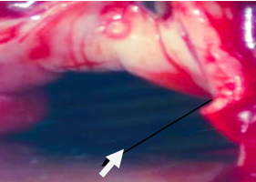 Foreign body in upper vagina