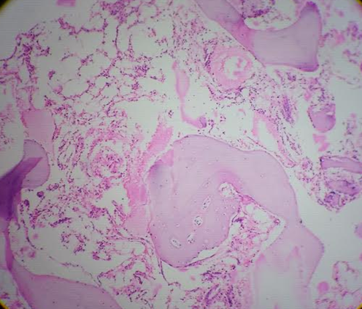 Bone marrow biopsy (5983/15) - Aplastic anemia in an 8 year old male child (H and E, 4X)