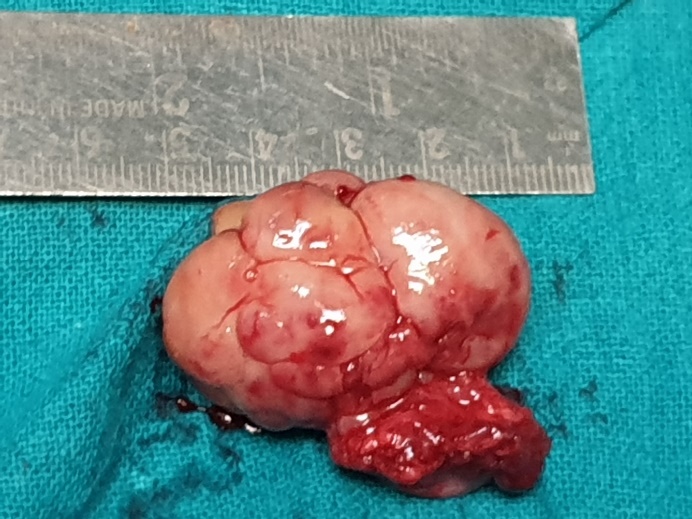 The excised mass measured 5* 4*5 cm, with a visible stalk