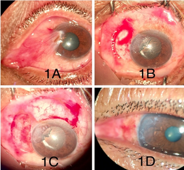Surgical technique; A): Pre operative; B):  After pterygium excision; C): Conjunctival graft in place; D): POD 1)