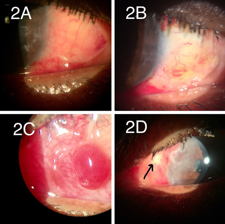 Post operative complications; A): Graft edema on POD 1; B): edema resolved on POD 7 of same patient; C): Granuloma formation; D): Avascular patch [Arrow])