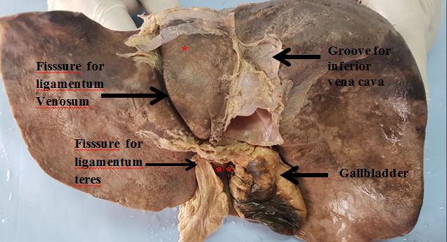Posterior and Inferior surface of Normal Liver