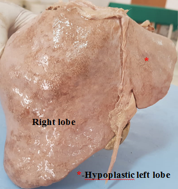  Hypoplastic left lobe of Liver