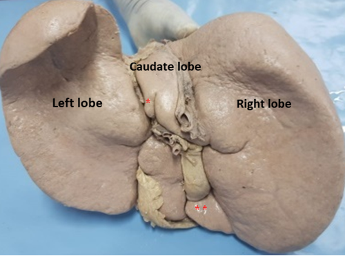 Accessory lobe s in various lobes of Liver 