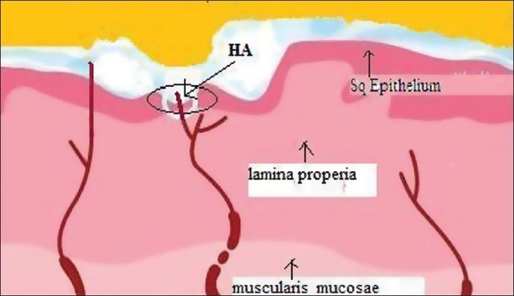 Topical hyaluronic acid (HA) forms a barrier film on exposed nerve endings