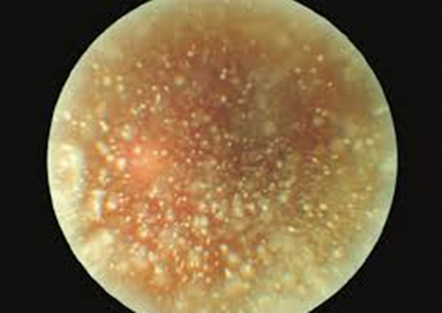 Asteroid hyalosis clinical appearance