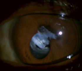 Posterior Synechiae