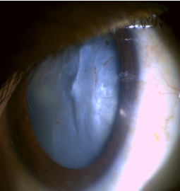 Anterior Capsular Rupture