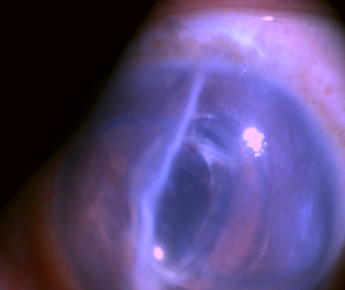 Corneal tear