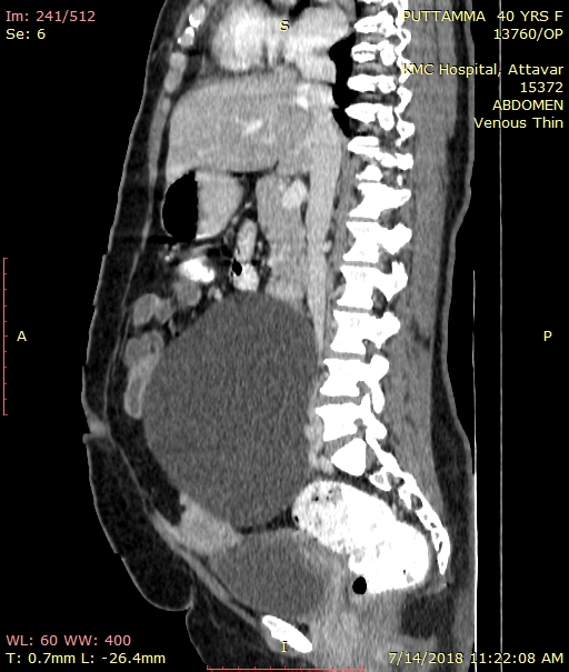 Sagittal CECT view showing the massextension from the upper end plate of L2 vertebra to the sacro-coccygealjunction