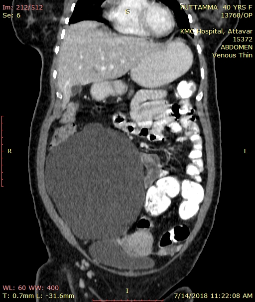 Coronal CECT view showing the cyst which isdisplacing the uterus and small bowel loops
