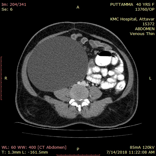 Axial CECT view showing that the cyst is extending upto the anterior abdominal wall, laterally reaching upto the lateral pelvicwall