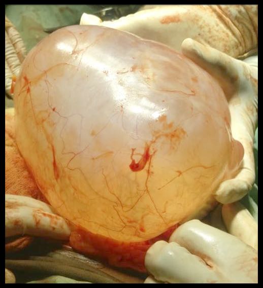 Intra operative cyst which is exteriorized.