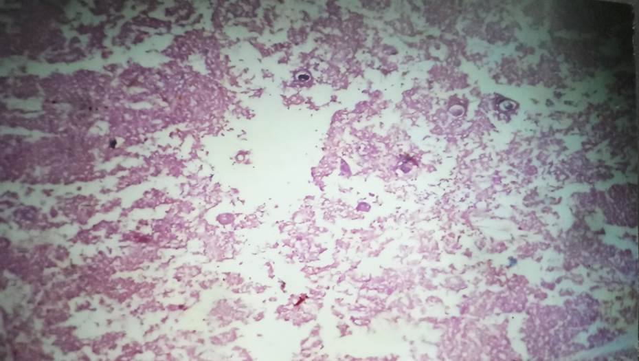 Medulla with Hassall’s corpuscle in 29 weeks fetus, H & E, 40x.