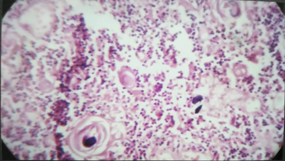 Medulla with Hassall’s corpuscle in 29 weeks fetus, H & E, 100x.
