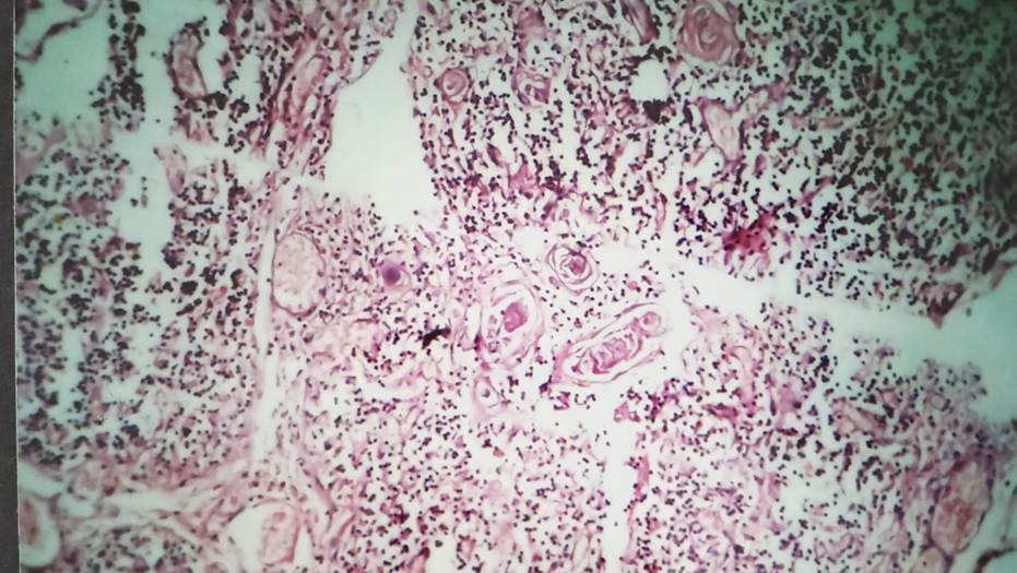 Medulla with Hassall’s corpuscle in 35 weeks fetus, H & E, 40x