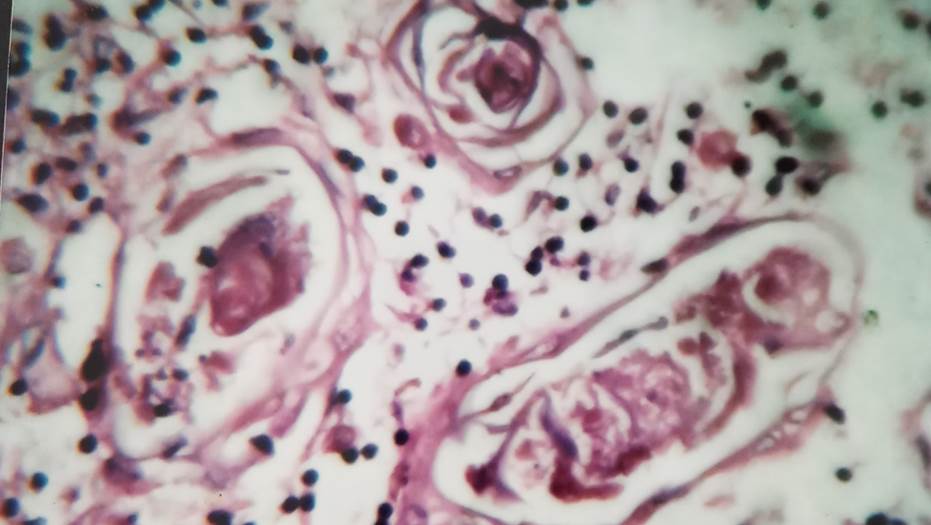 Medulla with Hassall’s corpuscle in 35 weeks fetus, H& E, 100x