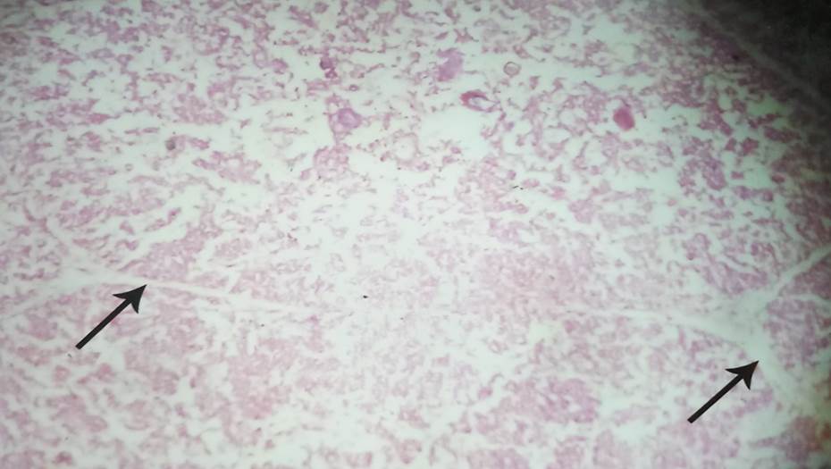Incomplete interlobular septa in 18 weeks fetus, H & E, 40x.