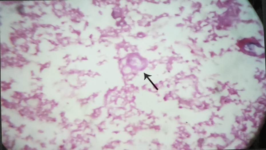 Hassall’s corpuscle in the medulla of 18 weeks fetus, H & E, 100x