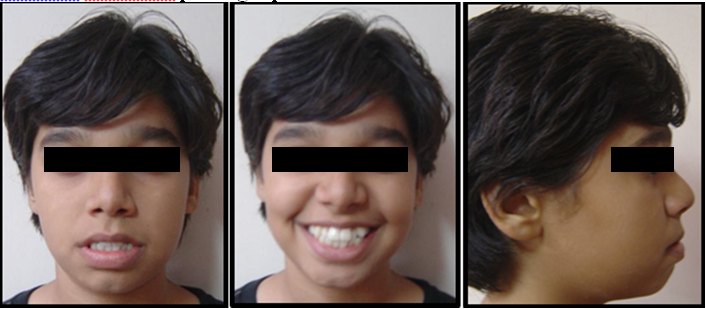 Pre treatment extraoral photographs