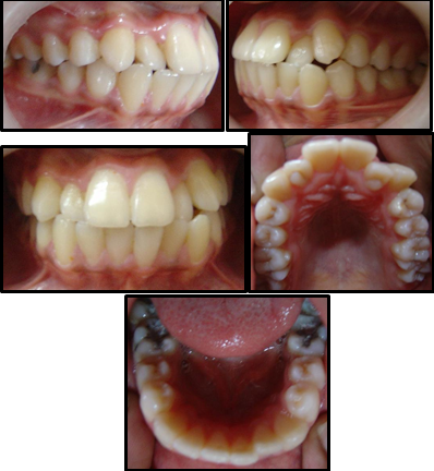 Pre treatment intraoral photographs