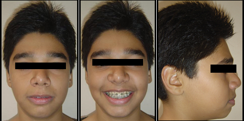 Treatment extraoral of fixed appliance therapy