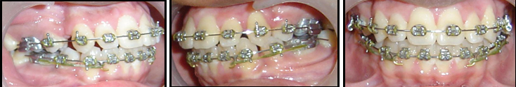 Treatment intraoral of fixed appliance therapy