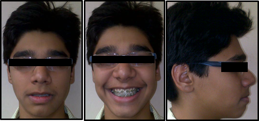 Pre finishing extraoral of fixed appliance therapy