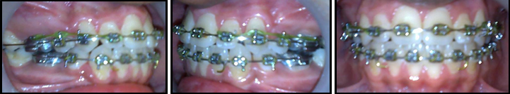 Pre finishing intraoral of fixed appliance therapy