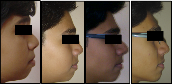 Comparison of pre, mid, pre finishing and post treatment profiles