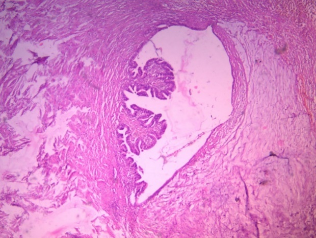 Shows the left fallopian tube.