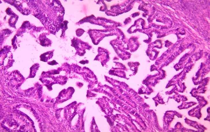 Shows papillary serous adenocarcinoma of endocervix