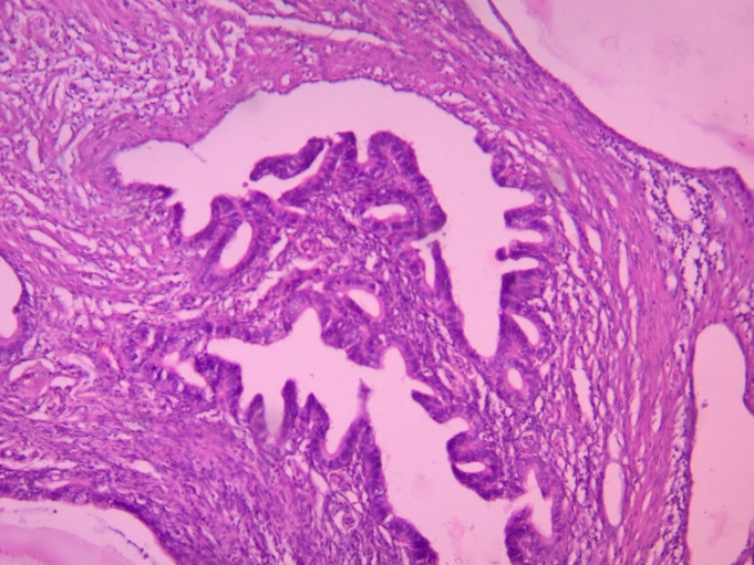 Shows papillary serous adenocarcinoma of the left fallopian tube