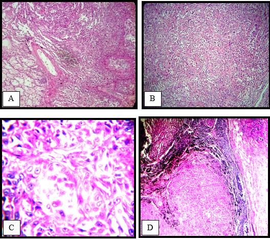 Microphotograph of metastatic carcinoma of lung a), b)& c): lung(H & E x40, 100,400), d): Lymph node metastasis (H & E x100)