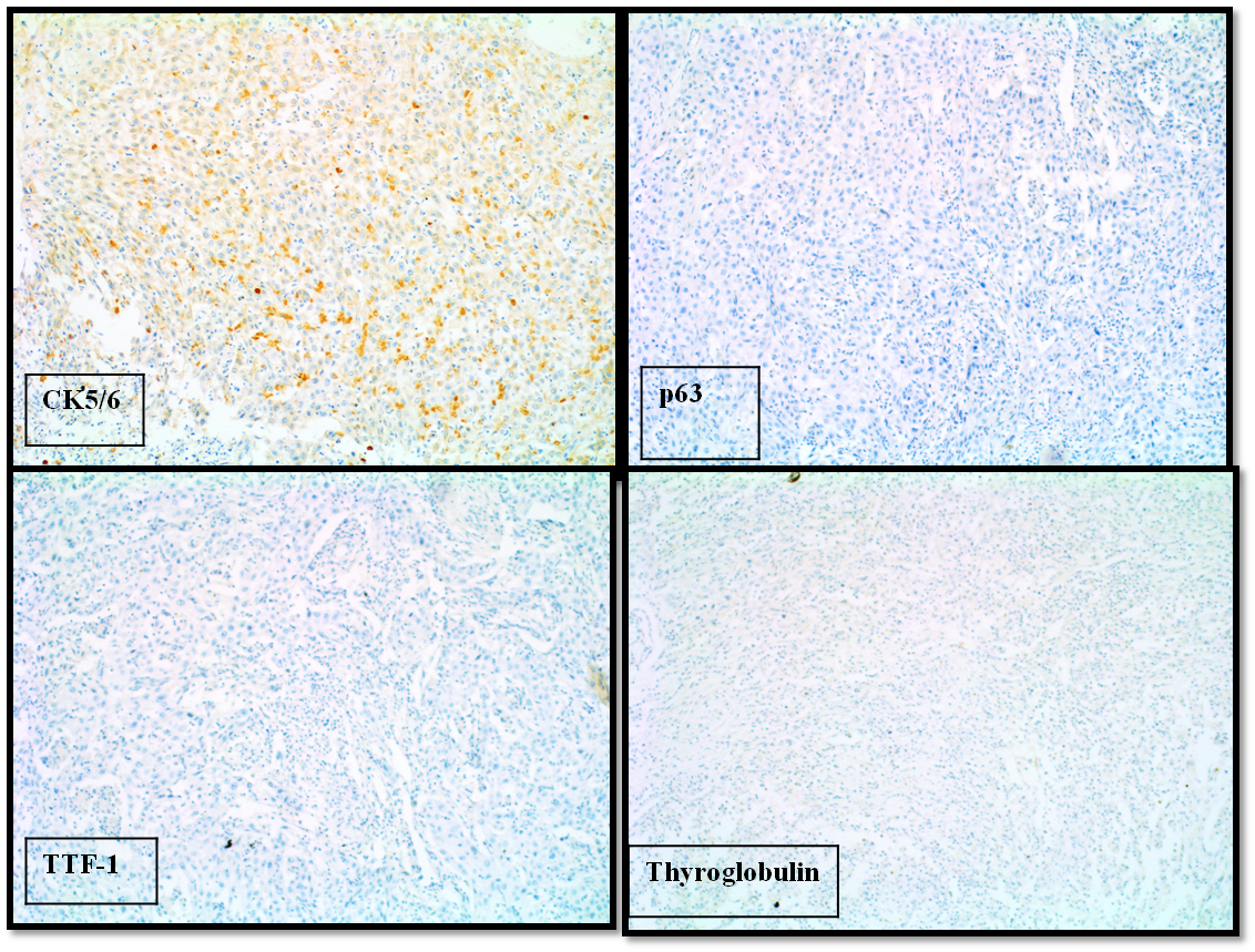 Microphotograph showing positivity for CK5/6, negative for p63, TTF-1, Thyroglobulin (X 200)