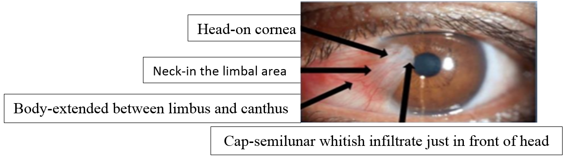 Parts of pterygium 